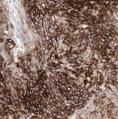 Immunohistochemistry-Paraffin: CD44 Antibody (CL13318) [NBP3-18578] - Staining of human cervical cancer shows strong membranous positivity in tumor cells.