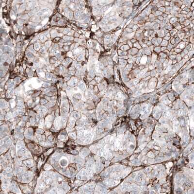 Immunohistochemistry-Paraffin: CD44 Antibody (CL13318) [NBP3-18578] - Staining of human breast cancer (metastasis to ovary) shows moderate membranous positivity in tumor cells.