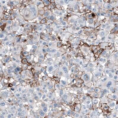 Immunohistochemistry-Paraffin: CD44 Antibody (CL13318) [NBP3-18578] - Staining of human malignant melanoma shows moderate membranous positivity in tumor cells.