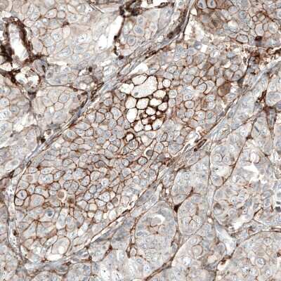 Immunohistochemistry-Paraffin: CD44 Antibody (CL13318) [NBP3-18580] - Staining of human breast cancer (metastasis to ovary) shows moderate membranous positivity in tumor cells.