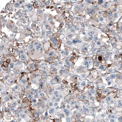 Immunohistochemistry-Paraffin: CD44 Antibody (CL13318) [NBP3-18580] - Staining of human malignant melanoma shows moderate membranous positivity in tumor cells.