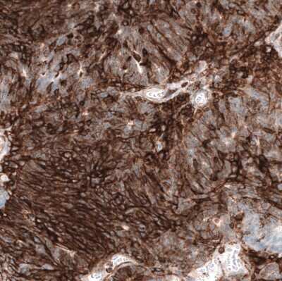 Immunohistochemistry-Paraffin: CD44 Antibody (CL13324) [NBP3-18566] - Staining of human ovarian cancer (endometrioid carcinoma) shows strong membranous positivity in tumor cells.