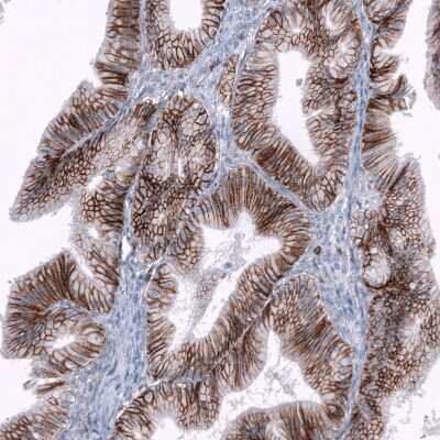 Immunohistochemistry-Paraffin: CD44 Antibody (CL13324) [NBP3-18566] - Staining of human ovarian cancer (low grade carcinoma) shows moderate membranous positivity in tumor cells.