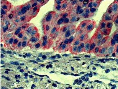 Immunohistochemistry-Paraffin: CD44 Antibody (F10-44-2) [NBP1-28385] - Human gastric cancer tissue was stained with Mouse Anti-Human CD44-UNLBfollowed by Goat Anti-Mouse IgG2a, Human ads-AP  Red AP, hematoxylin, and mounted with Fluoromount-G®.  