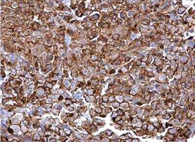 Immunohistochemistry-Paraffin: CD44 Antibody [NBP2-15809] - Paraffin-embedded human ovarian carcinoma. CD44 antibody [N1N2], N-term diluted at 1:500.