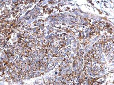 Immunohistochemistry-Paraffin: CD44 Antibody [NBP2-15809] -  Paraffin-embedded human breast carcinoma. CD44 antibody [N1N2], N-term diluted at 1:500.