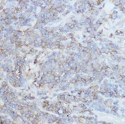 Immunohistochemistry-Paraffin: CD44 Antibody [NBP2-92947] - Human lung cancer using CD44 Rabbit pAb at dilution of 1:250 (40x lens).