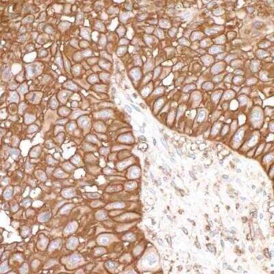 Immunohistochemistry-Paraffin: CD44 Antibody [NBP3-14671] - FFPE section of head and neck squamous cell carcinoma. Rabbit anti-CD44 recombinant monoclonal antibody [BLR038F] (NBP3-14671 lot 1) used at 1:500. HRP-conjugated goat anti-rabbit IgG (NB100-2332). Substrate: DAB