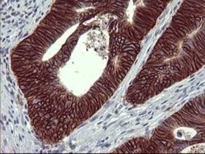 Immunohistochemistry: CD44 Antibody (OTI1E3) - Azide and BSA Free [NBP2-70379] - Analysis of Carcinoma of Human pancreas tissue.