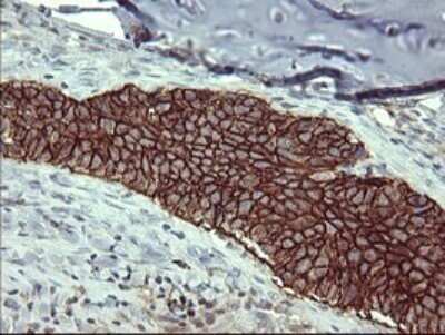 Immunohistochemistry: CD44 Antibody (OTI1E3) [NBP2-46151] - Analysis of Carcinoma of Human lung tissue.