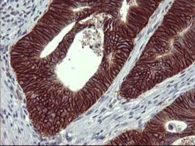 Immunohistochemistry: CD44 Antibody (OTI1E3) [NBP2-46151] - Analysis of Carcinoma of Human pancreas tissue.