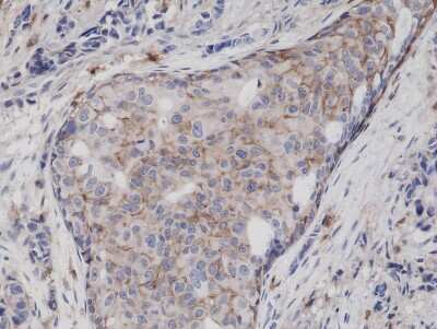Immunohistochemistry: CD44 Antibody (RM264) [NBP2-61511] - Immunohistochemical staining of formalin fixed and paraffin embedded Human breast cancer tissue sections using NBP2-61511.