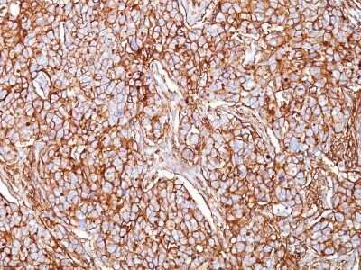 Immunohistochemistry-Paraffin: CD44 Antibody (SPM521) - IHC-Prediluted [NBP2-48407] - Human Breast Carcinoma stained with CD44 Monoclonal Antibody (SPM521)