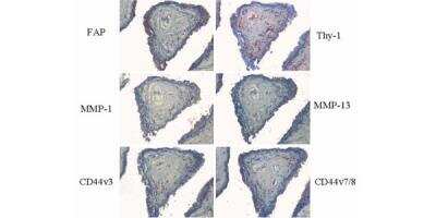 Immunohistochemistry: CD44 Antibody (VFF-17) - variant 7/8 [NB100-65535] - Analysis of activation markers in synovial membranes of osteoarthritis. Phenotypic markers that are instrumental in extracellular matrix alteration are detectable only at a low level (MMP-1, CD44v7/8) in areas that are slightly FAP-positive. FAP, fibroblast activation protein; MMP, matrix metalloproteinase.