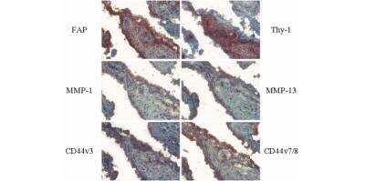 Immunohistochemistry: CD44 Antibody (VFF-17) - variant 7/8 [NB100-65535] - Analysis of activation markers in synovial membranes of rheumatoid arthritis. Expression of fibroblast activation protein (FAP) is accompanied by accumulation of activation markers (MMP-1 and MMP-13) and splice variants of CD44 (v3 and v7/8) that are known to correlate with the degree of inflammation and that are involved in extracellular matrix deposition. 