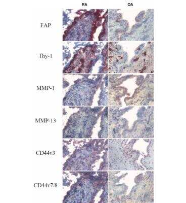 Immunohistochemistry: CD44 Antibody (VFF-17) - variant 7/8 [NB100-65535] - Analysis of representative areas of synovial tissue samples taken from patients with end-stage osteoarthritis (OA) or refractory rheumatoid arthritis (RA) is shown. Expression pattern and staining intensity of RA samples represent the stronger intensity of synovial inflammation when compared with OA samples. 