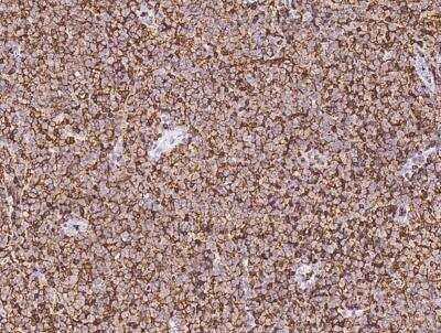 Immunohistochemistry-Paraffin: CD45 Antibody (145) [NBP2-89219] - Staining of human LCA in human lymphoma with rabbit monoclonal CD45 Antibody (145) [NBP2-89219] at 1:200 dilution.