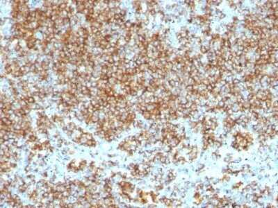 Immunohistochemistry-Paraffin: CD45 Antibody (SPM569 + SPM570) - Azide and BSA Free [NBP2-34430] - Formalin-fixed, paraffin-embedded human Lymphoma stained with CD45 Antibody (SPM569 + SPM570) [NBP2-34430].