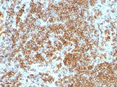 Immunohistochemistry-Paraffin: CD45RB Antibody (PTPRC/1132) - IHC-Prediluted [NBP2-48459] - Formalin-fixed, paraffin-embedded human Lymphoma stained with CD45RB Monoclonal Antibody (PTPRC/1132).