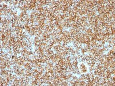 Immunohistochemistry-Paraffin: CD45RB Antibody (PTPRC/1147) - Azide and BSA Free [NBP2-47959] - Human Lymphoma stained with CD45RB Monoclonal Antibody (PTPRC/1147).