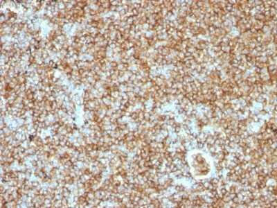 Immunohistochemistry-Paraffin: CD45RB Antibody (PTPRC/1147) [NBP2-44847] - Human Lymphoma stained with CD45RB Monoclonal Antibody (PTPRC/1147).