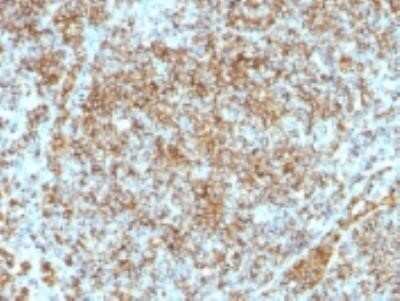 Immunohistochemistry-Paraffin: CD45RB Antibody (SPM569) - IHC-Prediluted [NBP2-44856] - Formalin-fixed, paraffin-embedded human lymphoma stained with CD45RB Monoclonal Antibody (SPM569)