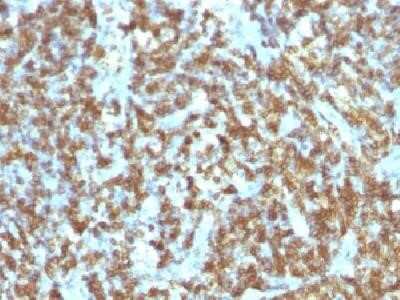 Immunohistochemistry-Paraffin: CD45RO Antibody (SPM125) - Azide and BSA Free [NBP2-34735] - Formalin-fixed. paraffin-embedded human Lymphoma stained with CD45RO Monoclonal Antibody SPM125