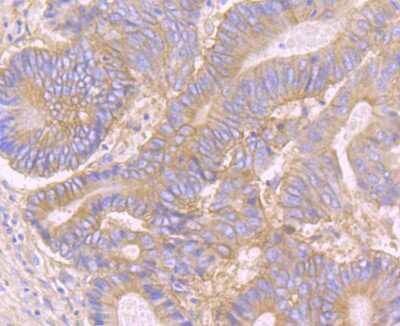 Immunohistochemistry-Paraffin: CD46 Antibody (JB25-49) [NBP2-75436] - Analysis of paraffin-embedded human colon cancer tissue using anti-CD46 antibody. Counter stained with hematoxylin.