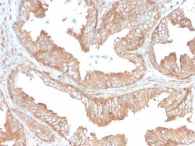 Immunohistochemistry-Paraffin: CD47 Antibody (CD47/3019) - Azide and BSA Free [NBP3-08976] - Immunohistochemistry-Paraffin: CD47 Antibody (CD47/3019) - Immunohistochemistry-Paraffin: CD47 Antibody (CD47/3019) [NBP3-08975] - Formalin-fixed, paraffin-embedded human prostate carcinoma stained with CD47 Mouse Monoclonal Antibody (CD47/3019).