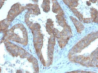 Immunohistochemistry-Paraffin: CD47 Antibody (CD47/3019) - Azide and BSA Free [NBP3-08976] - Immunohistochemistry-Paraffin: CD47 Antibody (CD47/3019) - Immunohistochemistry-Paraffin: CD47 Antibody (CD47/3019) [NBP3-08975] - Formalin-fixed, paraffin-embedded human prostate carcinoma stained with CD47 Mouse Monoclonal Antibody (CD47/3019).