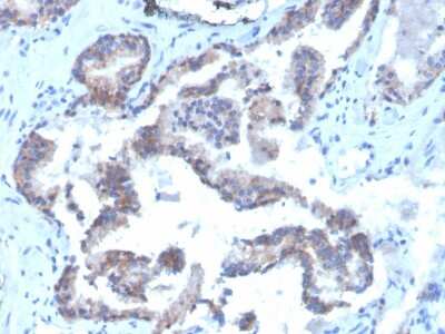 Immunohistochemistry-Paraffin: CD47 Antibody (CD47/3019) - Azide and BSA Free [NBP3-08976] - Formalin-fixed, paraffin-embedded human Prostate Carcinoma stained with Biotin-conjugated CD47 Mouse Monoclonal Antibody (IAP/3019).