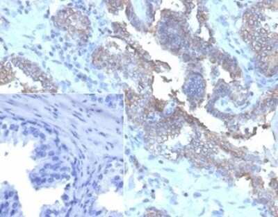 Immunohistochemistry-Paraffin: CD47 Antibody (CD47/6362R) - Azide and BSA Free [NBP3-08218] - Formalin-fixed, paraffin-embedded human prostate carcinoma stained with CD47 Recombinant Rabbit Monoclonal Antibody (CD47/6362R). Inset: PBS used instead of primary as secondary antibody negative control