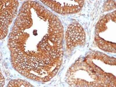 Immunohistochemistry-Paraffin: CD47 Antibody (CD47/6362R) [NBP3-07224] - Formalin-fixed, paraffin-embedded human prostate carcinoma stained with CD47 Recombinant Rabbit Monoclonal Antibody (CD47/6362R).