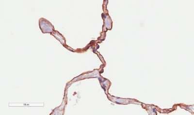 Immunohistochemistry: CD55/DAF Antibody (LU30) - Chimeric [NBP2-62562] - Immunohistochemical staining of human lung tissue using anti-CD55 antibody. LU30 Anti-CD55 (Complement decay-accelerating factor)staining of paraffin embedded human lung tissue using the rabbit-chimeric version of LU30 (NBP2-62562). Antigen retreival was acheived by microwaving in citrate buffer (pH6), followed by blocking with protein block serum-free buffer. Primary antibody incubation with NBP2-62562 was carried out at 4 ug/ml for 30 minutes. Samples were then incubated with an anti-rabbit IgG HRP secondary antibody for 20 mins followed by DAB (3,3'-diaminobenzidine), and counter staining with haematoxylin. Strong staining of the epithelial surface of alveoli may be observed. Recommended concentration, 2-4 ug/ml.