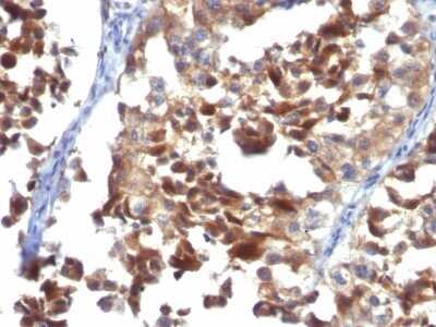 Immunohistochemistry-Paraffin: CD63 Antibody (LAMP3/968) - IHC-Prediluted [NBP2-48021] - Formalin-fixed, paraffin-embedded human Melanoma stained with CD63 Antibody (LAMP3/968)