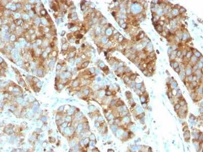 Immunohistochemistry-Paraffin: CD63 Antibody (LAMP3/968) - IHC-Prediluted [NBP2-48021] - Formalin-fixed, paraffin-embedded human Prostate Carcinoma stained with CD63 Antibody (LAMP3/968)