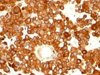 Immunohistochemistry-Paraffin: CD63 Antibody (MX-49.129.5) - IHC-Prediluted [NBP2-44808] - Formalin-fixed, paraffin-embedded human melanoma stained with CD63 Antibody (MX-49.129.5)