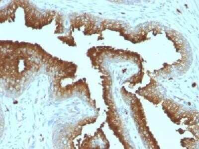 Immunohistochemistry-Paraffin: CD63 Antibody (MX-49.129.5) - IHC-Prediluted [NBP2-44808] - Formalin-fixed, paraffin-embedded human prostate carcinoma stained with CD63 Monoclonal Antibody (MX-49. 129.5)