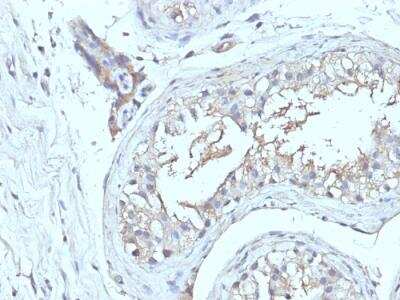 Immunohistochemistry-Paraffin: CD63 Antibody (NKI/C3 + LAMP3/968) - Azide and BSA Free [NBP2-47937] - Human Testicular Ca stained with CD63 Monoclonal Antibody (NKI/C3 + LAMP3/968)