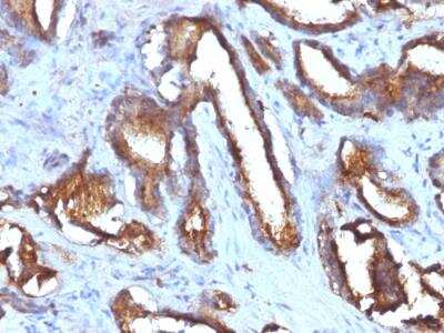 Immunohistochemistry-Paraffin: CD63 Antibody (NKI/C3 + LAMP3/968) - Azide and BSA Free [NBP2-47937] - Human Prostate Carcinoma stained with CD63 Monoclonal Antibody (NKI/C3 + LAMP3/968)