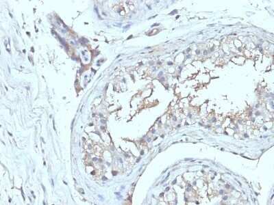 Immunohistochemistry-Paraffin: CD63 Antibody (NKI/C3 + LAMP3/968) - IHC-Prediluted [NBP2-48022] - Formalin-fixed, paraffin-embedded human Testicular Ca stained with CD63 Antibody (NKI/C3 + LAMP3/968)