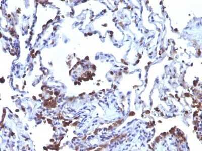 Immunohistochemistry-Paraffin: CD63 Antibody (NKI/C3 + LAMP3/968) - IHC-Prediluted [NBP2-48022] - Formalin-fixed, paraffin-embedded human Melanoma metastasized to Lung stained with CD63 Antibody (NKI/C3 + LAMP3/968)