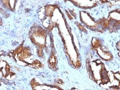 Immunohistochemistry-Paraffin: CD63 Antibody (NKI/C3 + LAMP3/968) - IHC-Prediluted [NBP2-48022] - Human Prostate Carcinoma stained with CD63 Monoclonal Antibody (NKI/C3 + LAMP3/968)