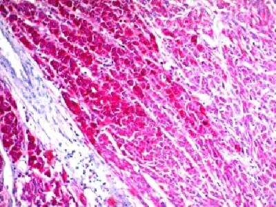 Immunohistochemistry-Paraffin: CD63 Antibody (NKI/C3) - Azide and BSA Free [NBP2-34694] - Formalin-fixed paraffin-embedded human Melanoma stained with CD63 Monoclonal Antibody (NKI/C3) (AEC Chomogen)