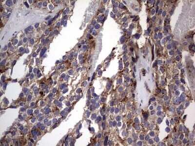 Immunohistochemistry: CD63 Antibody (OTI5E5) - Azide and BSA Free [NBP2-70380] - Analysis of Adenocarcinoma of Human breast tissue. (Heat-induced epitope retrieval by 1 mM EDTA in 10mM Tris, pH8.5, 120C for 3min)