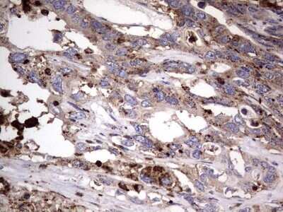 Immunohistochemistry: CD63 Antibody (OTI5E5) - Azide and BSA Free [NBP2-70380] - Analysis of Adenocarcinoma of Human colon tissue. (Heat-induced epitope retrieval by 1 mM EDTA in 10mM Tris, pH8.5, 120C for 3min)