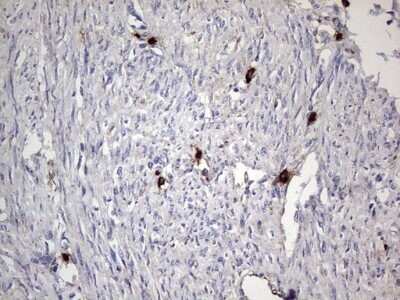 Immunohistochemistry: CD63 Antibody (OTI5E5) - Azide and BSA Free [NBP2-70380] - Analysis of Adenocarcinoma of Human endometrium tissue. (Heat-induced epitope retrieval by 1 mM EDTA in 10mM Tris, pH8.5, 120C for 3min)