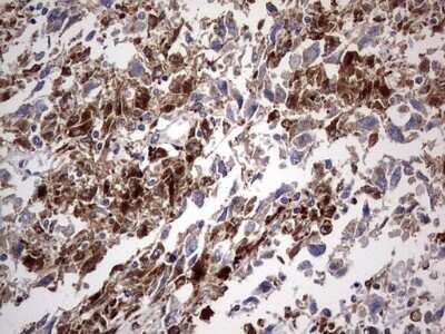 Immunohistochemistry: CD63 Antibody (OTI5E5) - Azide and BSA Free [NBP2-70380] - Analysis of Adenocarcinoma of Human ovary tissue. (Heat-induced epitope retrieval by 1 mM EDTA in 10mM Tris, pH8.5, 120C for 3min)