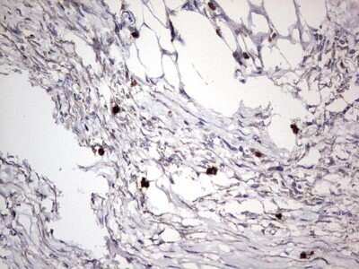 Immunohistochemistry: CD63 Antibody (OTI5E5) - Azide and BSA Free [NBP2-70380] - Analysis of Carcinoma of Human kidney tissue. (Heat-induced epitope retrieval by 1 mM EDTA in 10mM Tris, pH8.5, 120C for 3min)