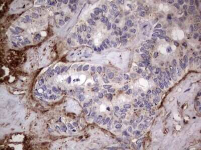 Immunohistochemistry: CD63 Antibody (OTI5E5) - Azide and BSA Free [NBP2-70380] - Analysis of Carcinoma of Human liver tissue.(Heat-induced epitope retrieval by 1 mM EDTA in 10mM Tris, pH8.5, 120C for 3min)